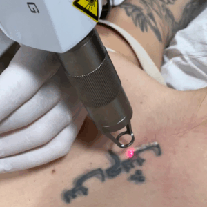 Imagen de eliminación de tatuaje mediano con Piocláser en Patricia Osorio's Beauty