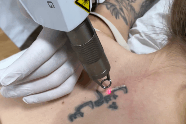 Imagen de eliminación de tatuaje mediano con Piocláser en Patricia Osorio's Beauty