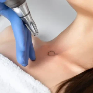 Imagen de eliminación de tatuajes pequeños con Picoláser en Patricia Osorio's Beauty