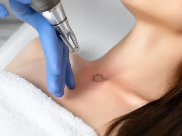 Imagen de eliminación de tatuajes pequeños con Picoláser en Patricia Osorio's Beauty