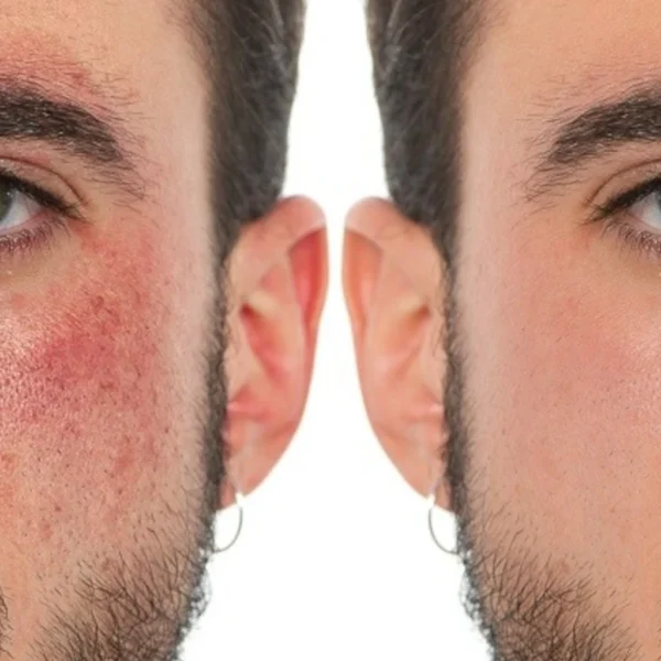 Imagen de tratamiento facial de eliminación de manchas en Patricia Osorio's Beauty