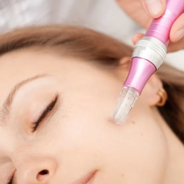Imagen de tratamiento facial de microneedling en Patricia Osorio's Beauty